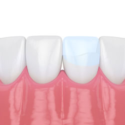 dental bonding