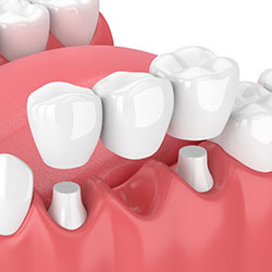 dental bridges