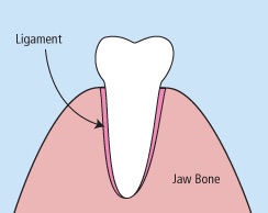 dental extractions