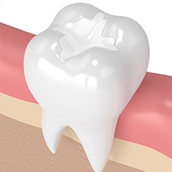 dental fillings