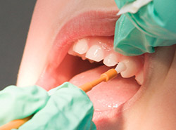 fluoride treatment 