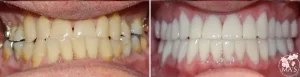 before and after image - dentist in Alexandria