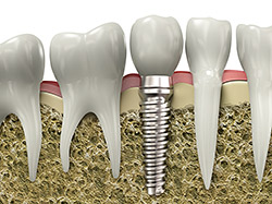 implant restoration