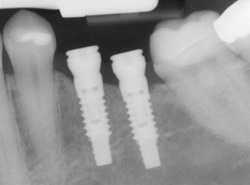 dental implant xray