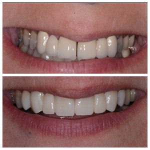 bridge implants before and after