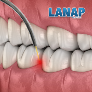 lanap surgery 