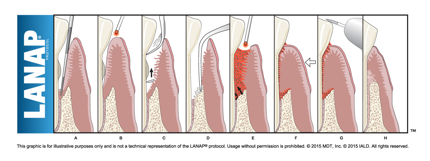 step by step graphic of lanap surgery